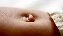 فتق ناف در نوزادان؛ چه زمانی بهبود می‌یابد؟