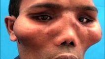 تغییر شکل عجیب صورت مرد جوان در اثر یک عارضه نادر!