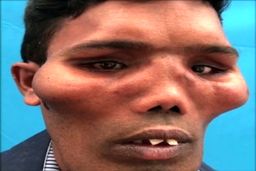 تغییر شکل عجیب صورت مرد جوان در اثر یک عارضه نادر!
