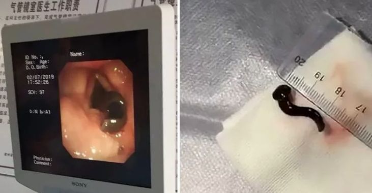 علت عجیب سرفه‌های مرد سالخورده یافت شد 