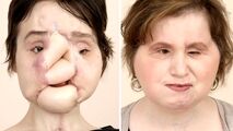عمل پیوند صورت، دختر جوان را به زندگی عادی برگرداند