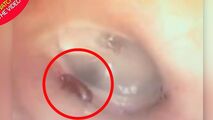 لحظه خارج کردن مورچه از گوش بیمار!