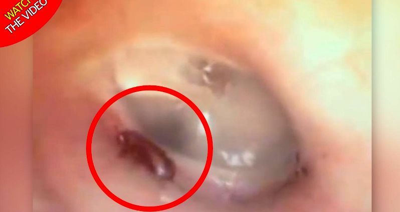 لحظه خارج کردن مورچه از گوش بیمار!
